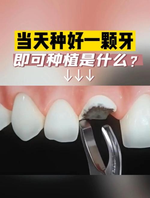 拔牙即刻种植 牙 青岛-图1