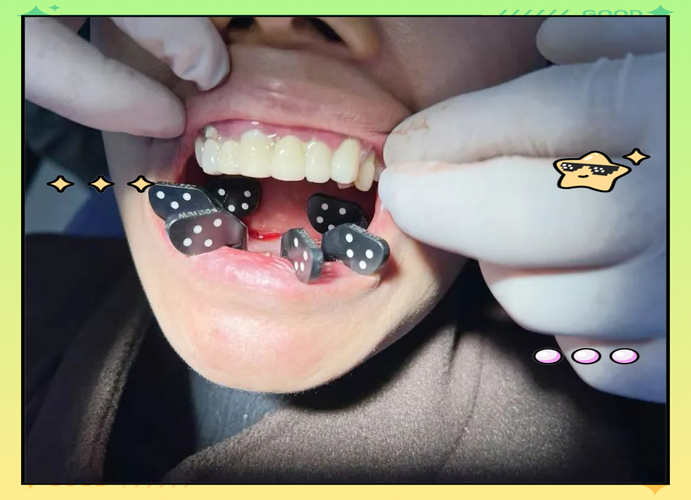 拔牙即刻种植 牙 青岛-图3