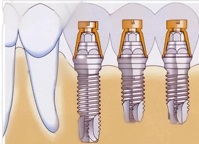 美国3i种植牙视频，核心技术优势有哪些？-图1