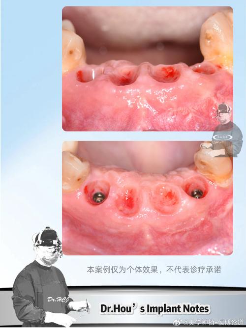 Bicon种植牙术后可能出现哪些并发症？-图3