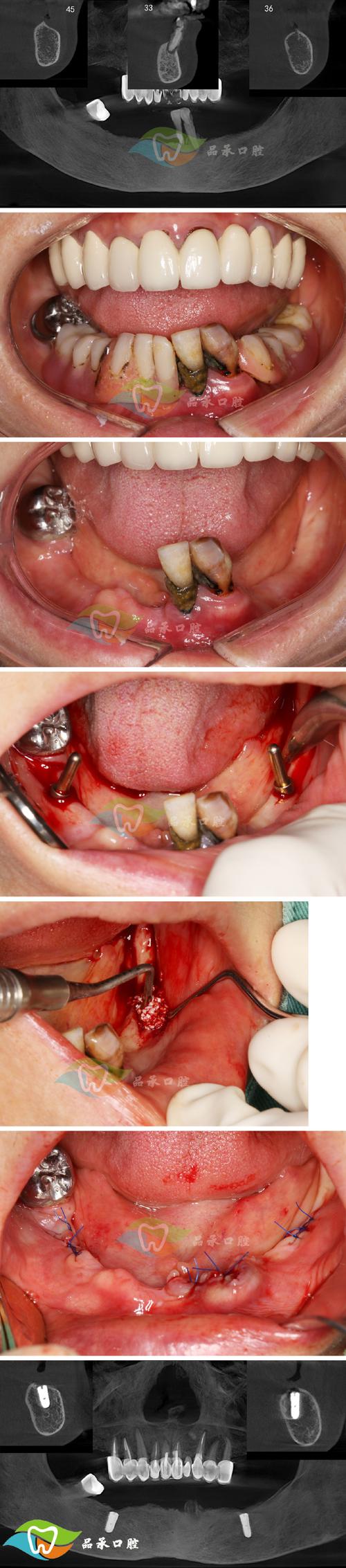 Bicon种植牙术后可能出现哪些并发症?-图1 Bicon种植牙术后可能出现哪些并发症?-图1
