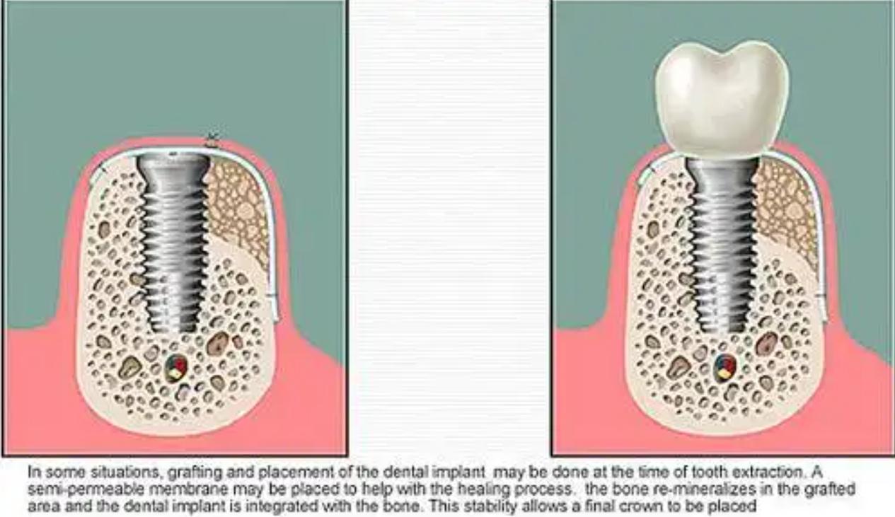种植牙植骨是什么?为何种植牙需要植骨?-图1 种植牙植骨是什么?为何种植牙需要植骨?-图1