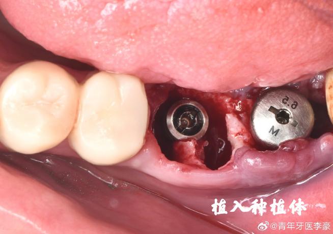 种植牙底部塞牙是什么原因?该怎么处理?-图1 种植牙底部塞牙是什么原因?该怎么处理?-图1