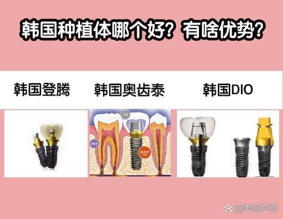 韩国DIO种植牙价格多少？一颗大概要花多少钱？-图2