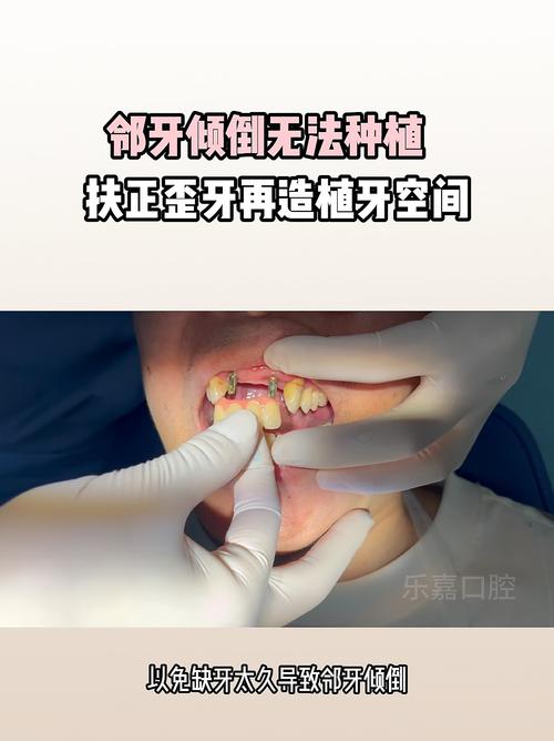 种植牙 邻牙 倾斜-图1