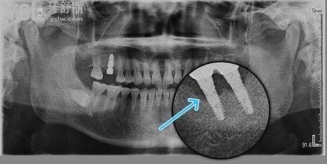 种植牙 邻牙 倾斜-图2