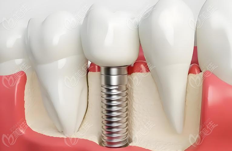 种植牙系统哪个好？品牌如何挑选适合自己的？-图3