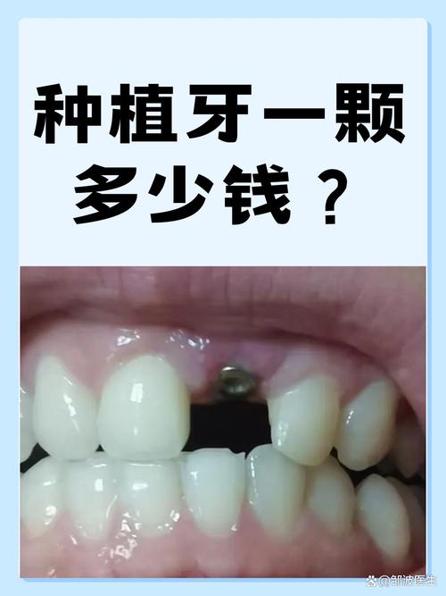 现在种植一颗牙-图3