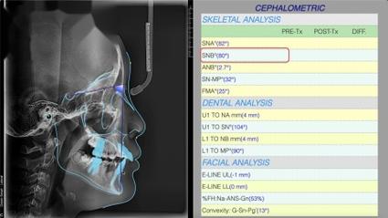 请问头影测量分析方法中1mp这一术语具体指什么意思?-图2 请问头影测量分析方法中1mp这一术语具体指什么意思?-图2
