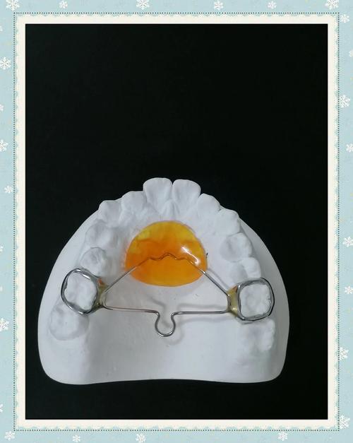 口腔正畸Nance弓的使用时机是什么时候?-图3 口腔正畸Nance弓的使用时机是什么时候?-图3