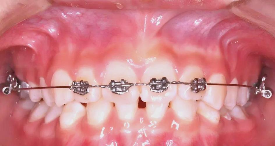 口腔正畸2 4矫治技术PPT-图1