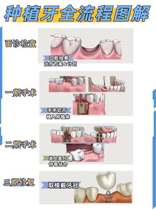 上颌骨缺损种牙的最佳时机是什么时候？-图1