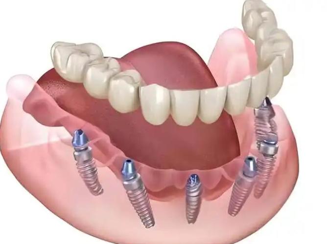 半口即刻种植牙种几颗最合适？-图1