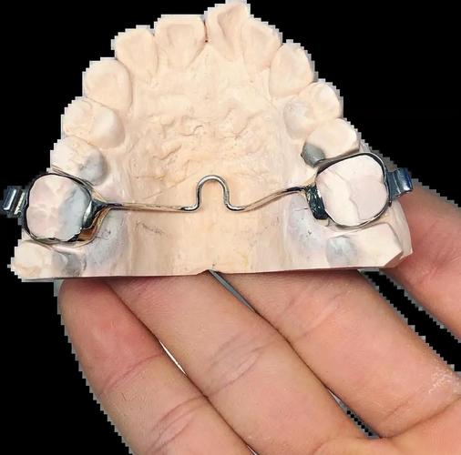 正畸TPA需要一直佩戴吗？-图1