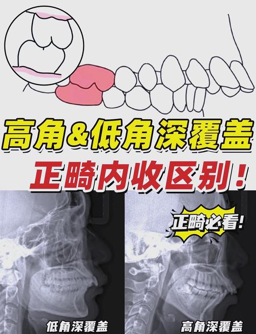 正畸III类倾向均角患者的矫治策略如何制定？-图2