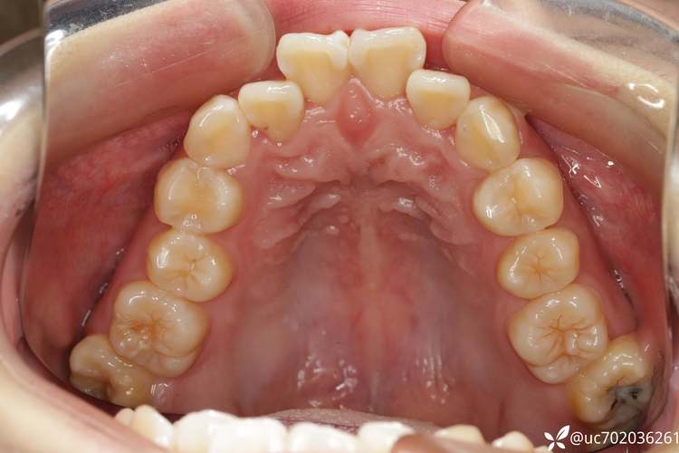 拔牙正畸T形曲应放在什么位置?-图3 拔牙正畸T形曲应放在什么位置?-图3