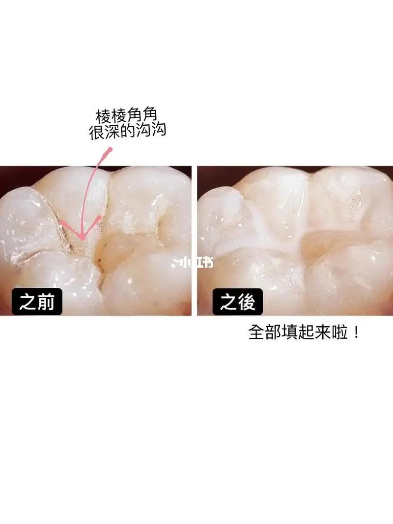 种牙封闭物掉落会引发感染吗?-图2 种牙封闭物掉落会引发感染吗?-图2