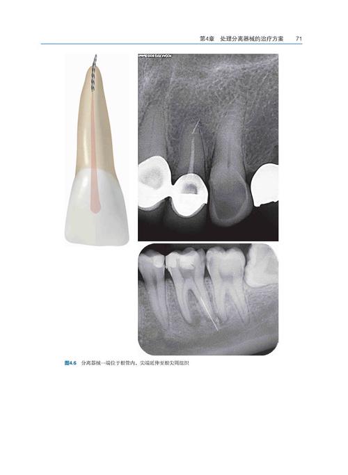 根管器械分离如何处理？常用方法有哪些？-图2