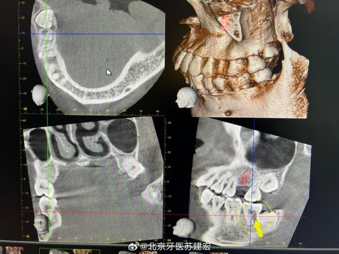 口腔科正畸CBCT拍摄的具体临床操作要求有哪些?-图3 口腔科正畸CBCT拍摄的具体临床操作要求有哪些?-图3