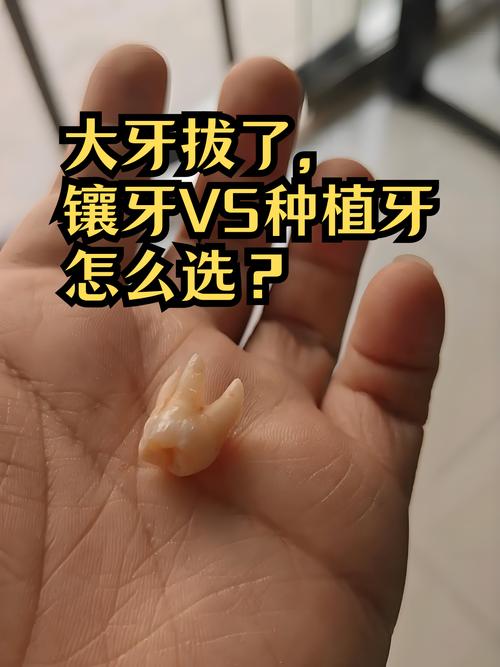 种牙后几天吃东西碰到了会有影响吗？-图3