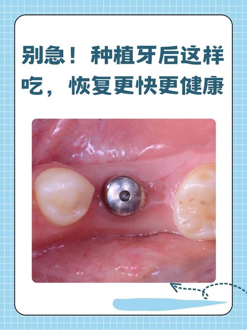 种牙后几天吃东西碰到了会有影响吗？-图1