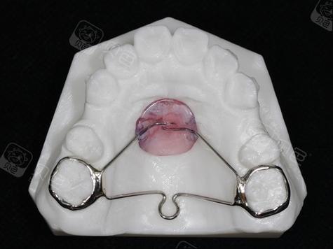 正畸nance弓属于哪种支抗类型？-图1