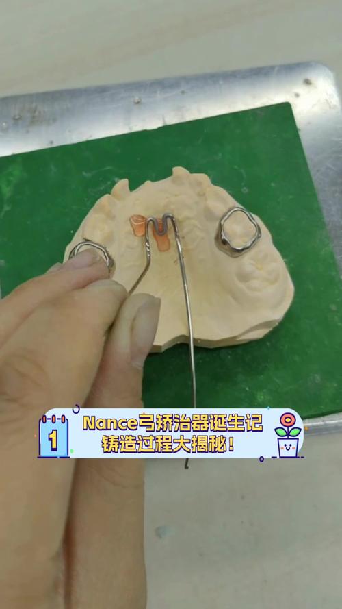 正畸nance弓属于哪种支抗类型？-图2