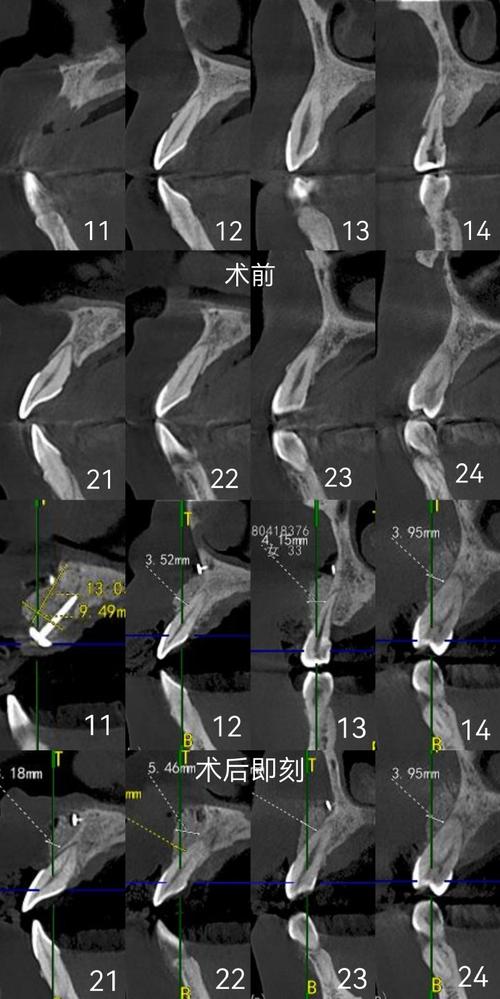paoo手术中,正畸医生的参与是否为治疗过程中不可或缺的一环?-图1 paoo手术中,正畸医生的参与是否为治疗过程中不可或缺的一环?-图1