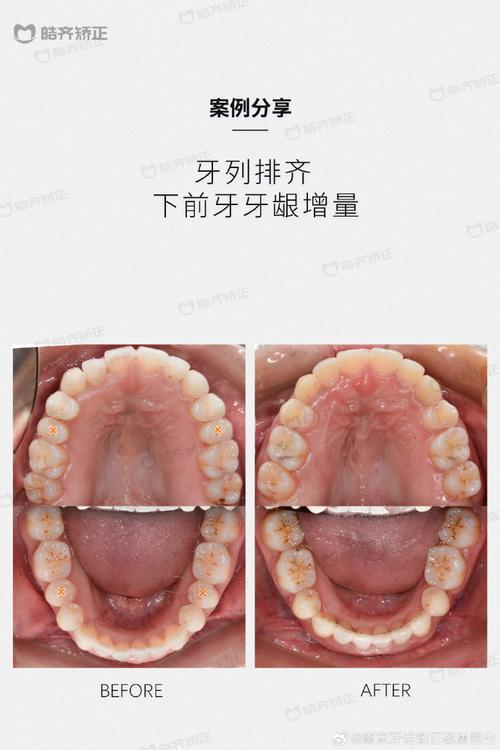 paoo手术中，正畸医生的参与是否为治疗过程中不可或缺的一环？-图2