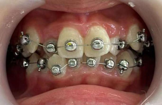 正畸治疗中MBT托槽粘结位置标准的临床应用关键要点有哪些?-图1 正畸治疗中MBT托槽粘结位置标准的临床应用关键要点有哪些?-图1