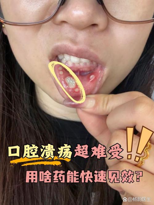 口腔溃疡为何总是反反复复？详细原因分析与有效治疗方法有哪些？-图2