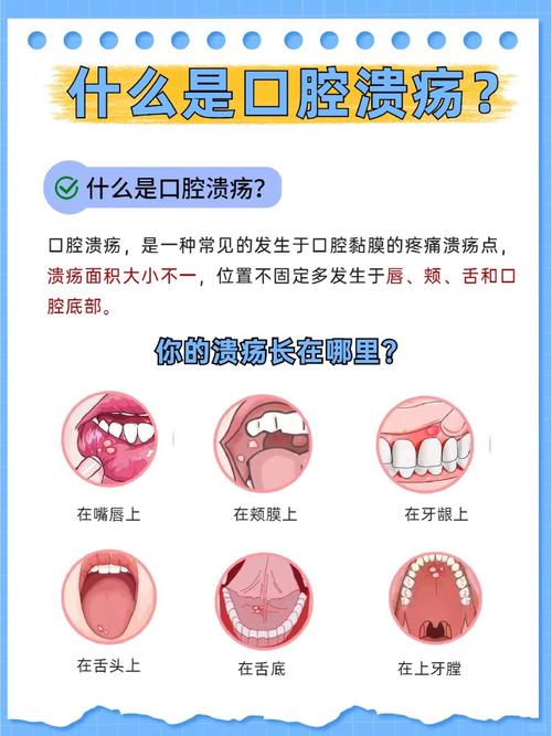 老年人口腔溃疡如何科学治疗？有哪些安全有效的专属疗法？-图1