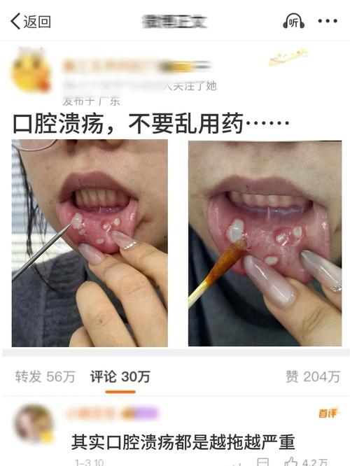 老年人口腔溃疡如何科学治疗？有哪些安全有效的专属疗法？-图2