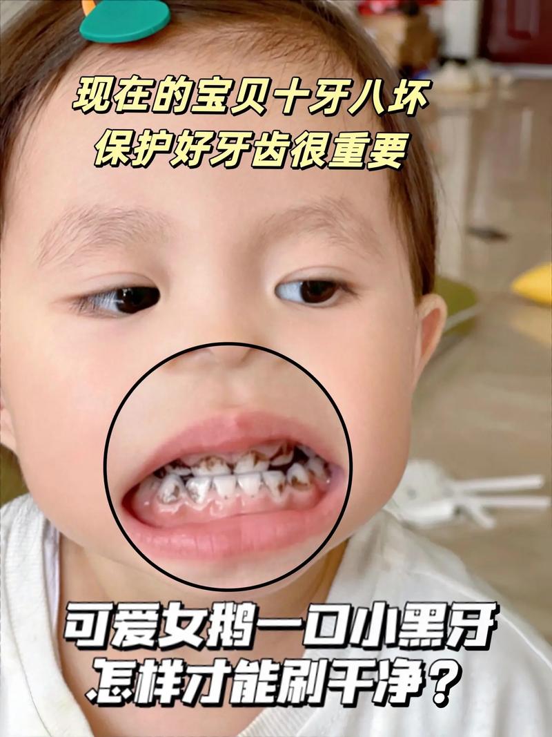 孩子大牙能种牙吗？需满足哪些条件？-图1