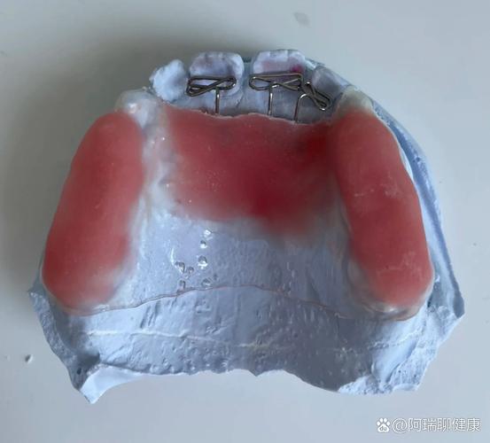 双曲舌簧矫治器制作方法-图1