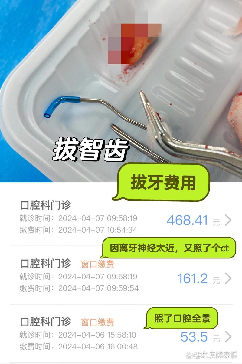 济南拜博口腔拔牙费用是多少？-图2