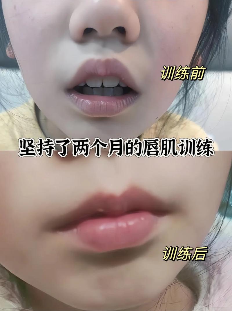 正畸后唇部肌肉如何有效锻炼？牙齿矫正者唇肌训练方法有哪些？-图2