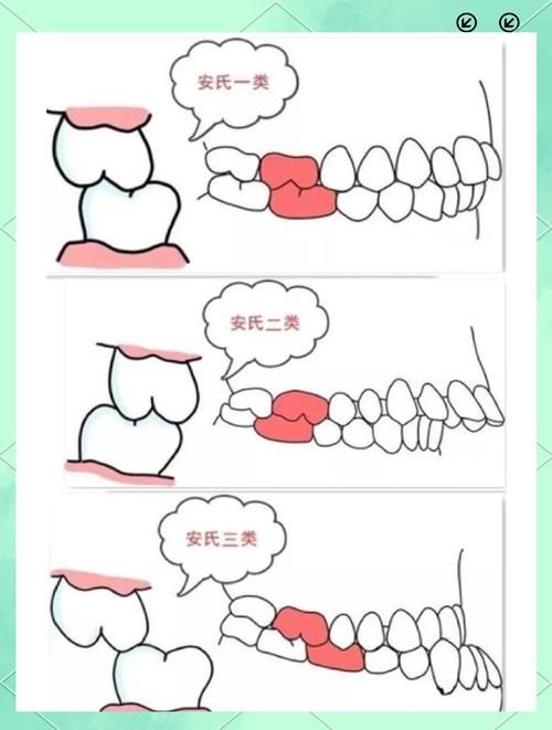 正畸安氏二类一分类病例的矫治要点有哪些？-图3