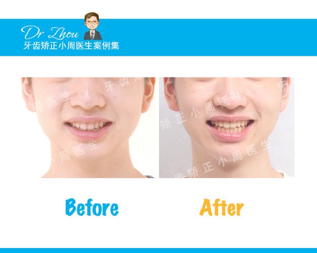 正畸结束后一年为何出现开合？-图2