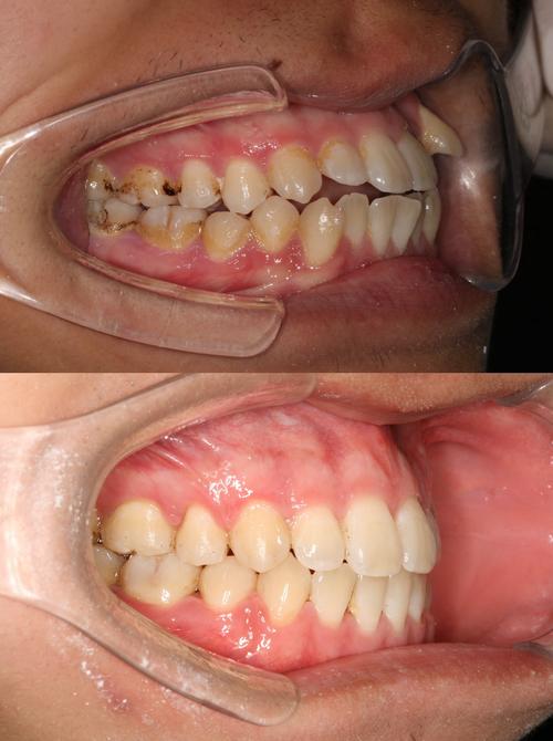 正畸结束后一年为何出现开合？-图1