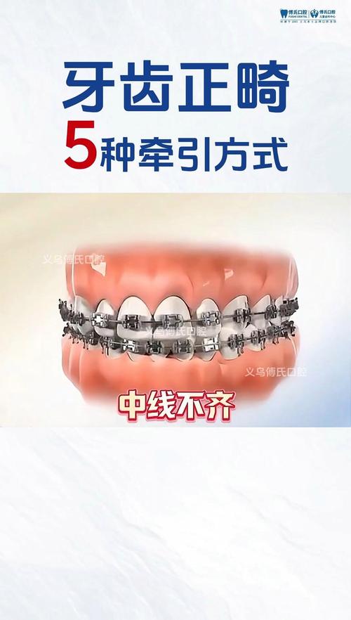 正畸二类牵引上牙2下牙4是为了达到什么效果?-图1 正畸二类牵引上牙2下牙4是为了达到什么效果?-图1