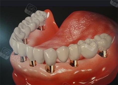 深圳allon4种植牙-图2