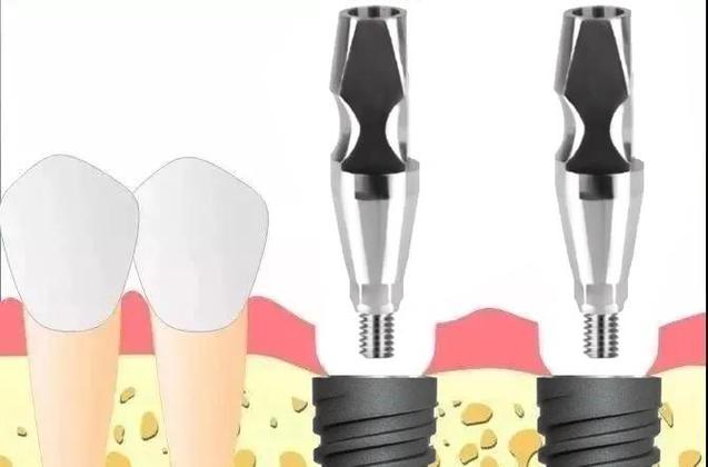 种植体取印模两方法有何不同？如何正确选择？-图3