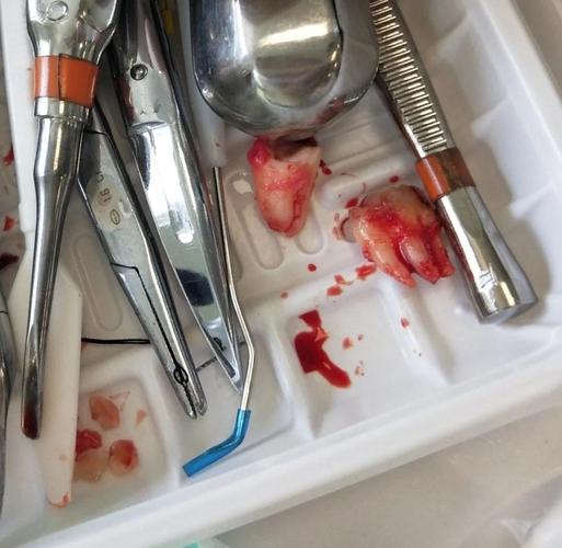 宁波拜博口腔医院拔智齿效果好不好？医生技术怎么样？-图1