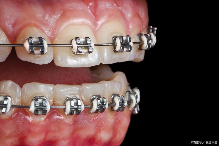 正畸拉簧一下拉5颗牙齿，效果真的安全又高效吗？-图2