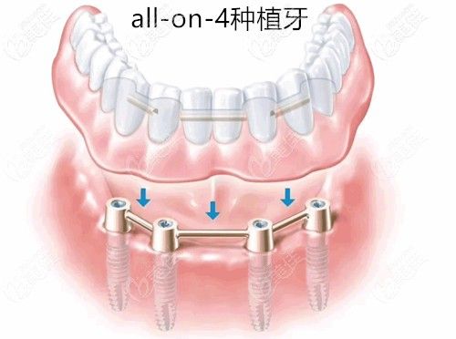 allon4种牙成功率怎样？影响因素有哪些？-图1