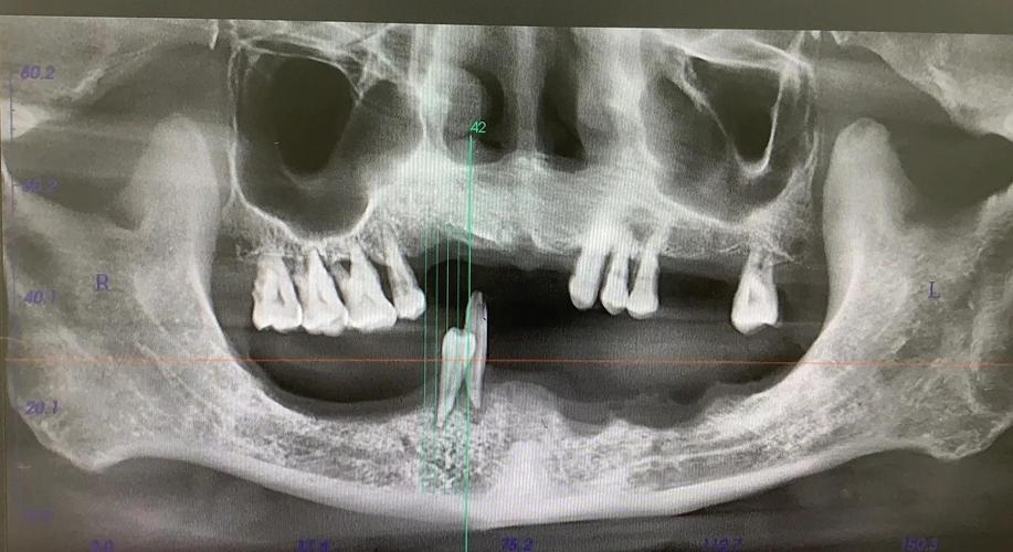 allon4种牙成功率怎样？影响因素有哪些？-图3