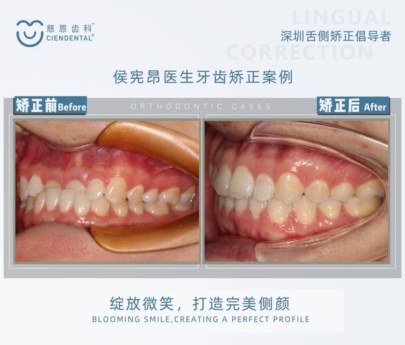 临沂市中医院正畸怎么样？效果专业度如何？-图3