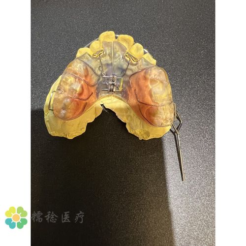 正畸螺旋扩弓器每转一圈对牙弓扩展效果如何?-图1 正畸螺旋扩弓器每转一圈对牙弓扩展效果如何?-图1