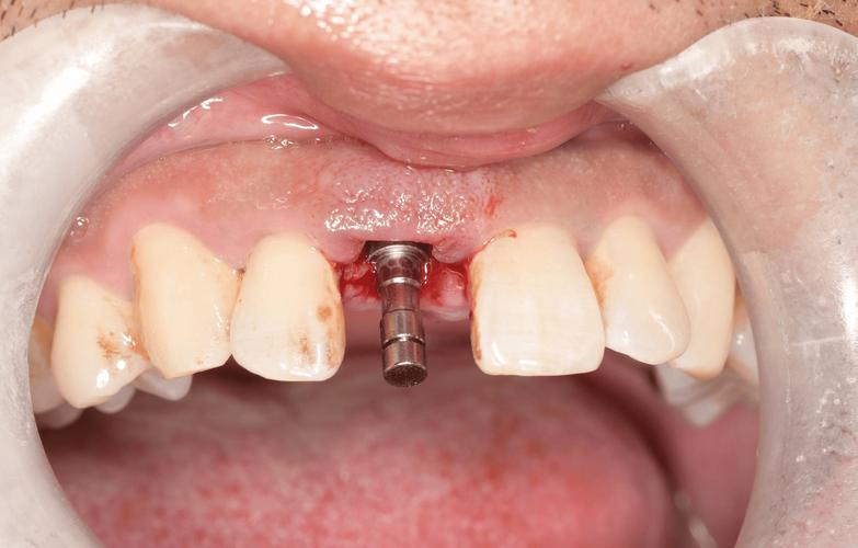 种牙术后口腔感觉有味道?原因分析与护理建议-图1 种牙术后口腔感觉有味道?原因分析与护理建议-图1